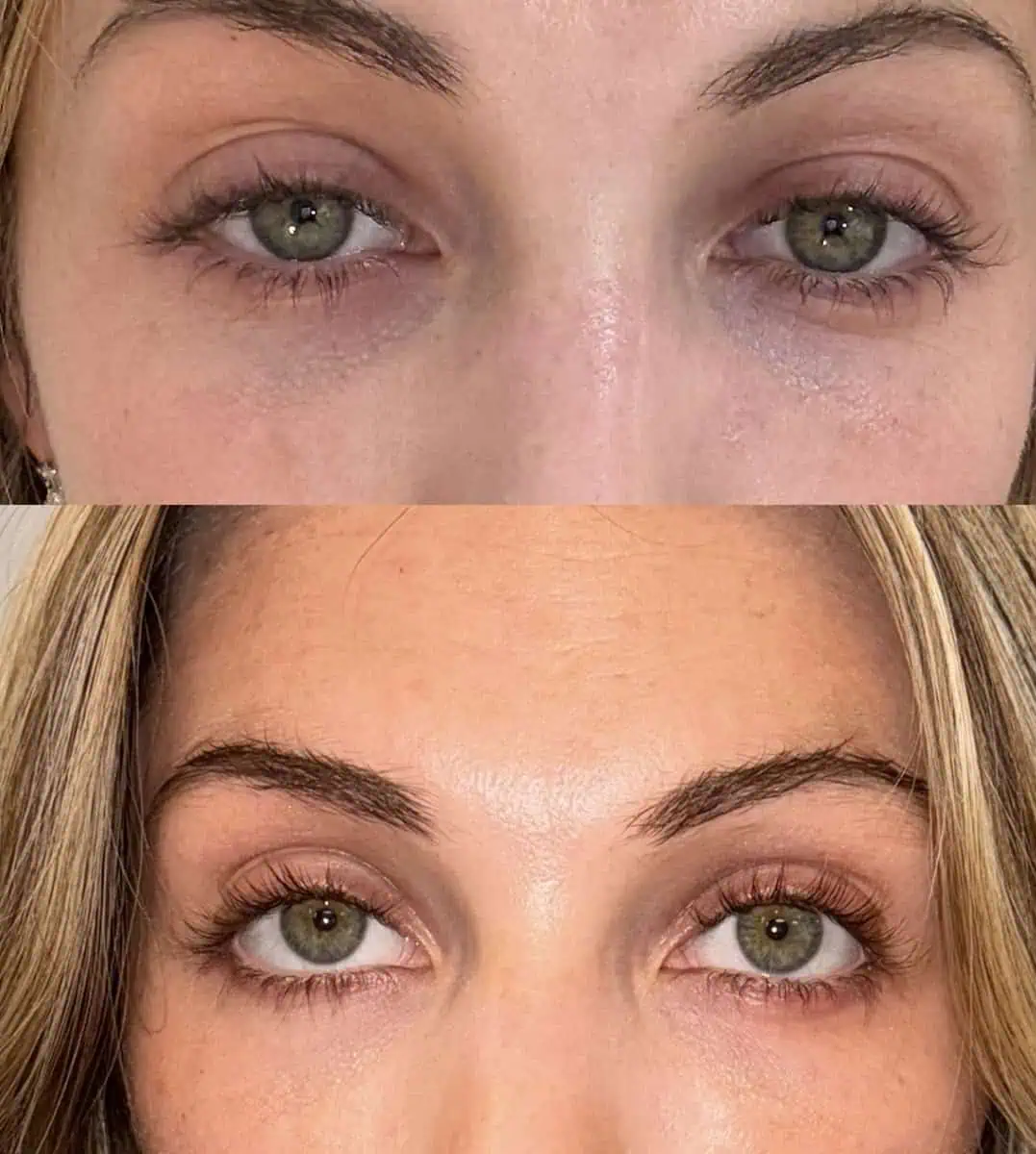 PRP/PRF Gel before and after results