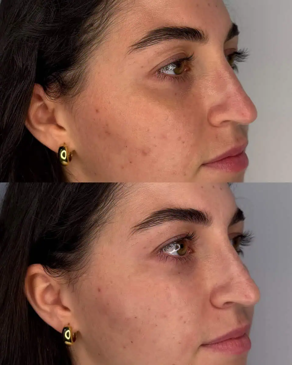 PRP/PRF Gel before and after results