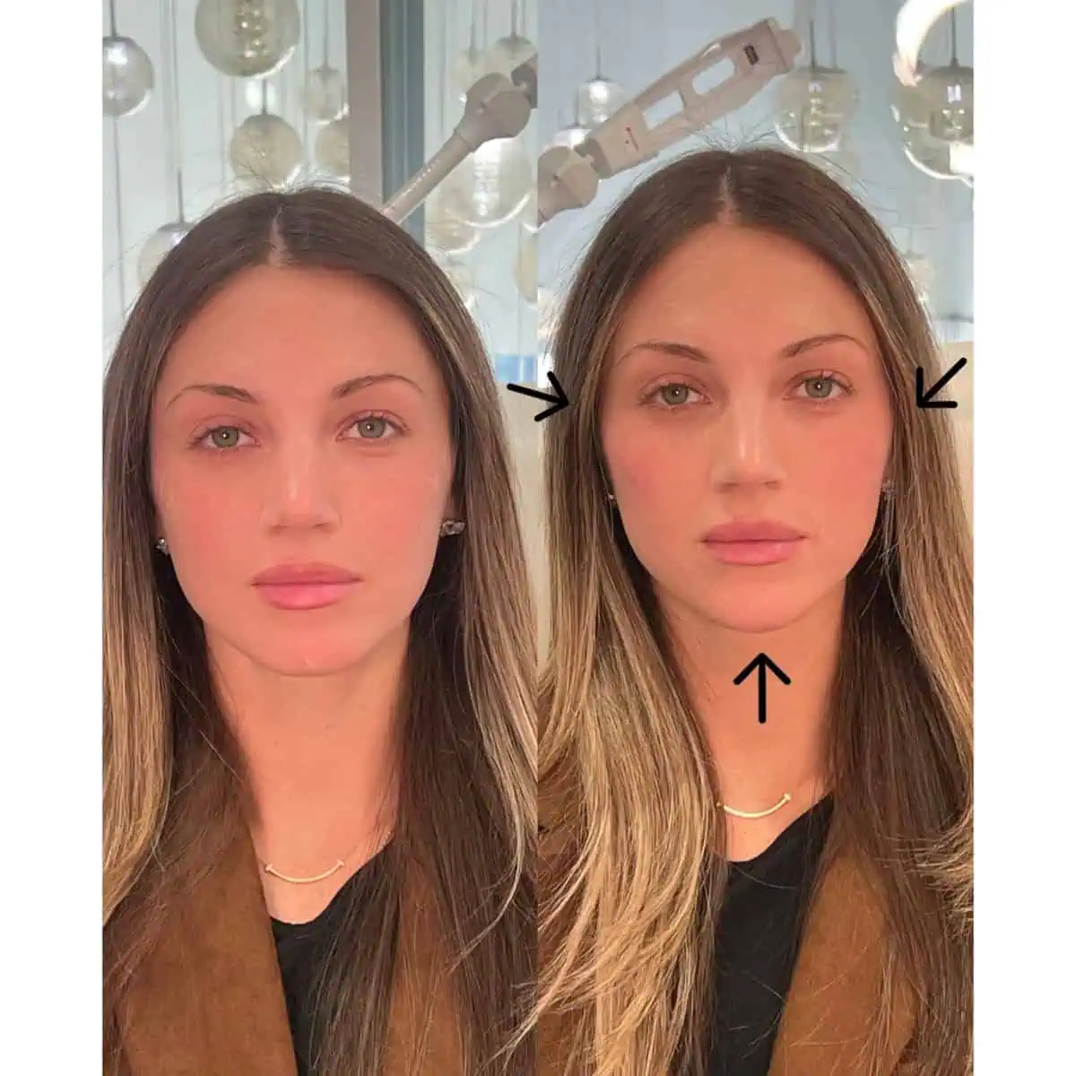 Facial Fillers before and after results