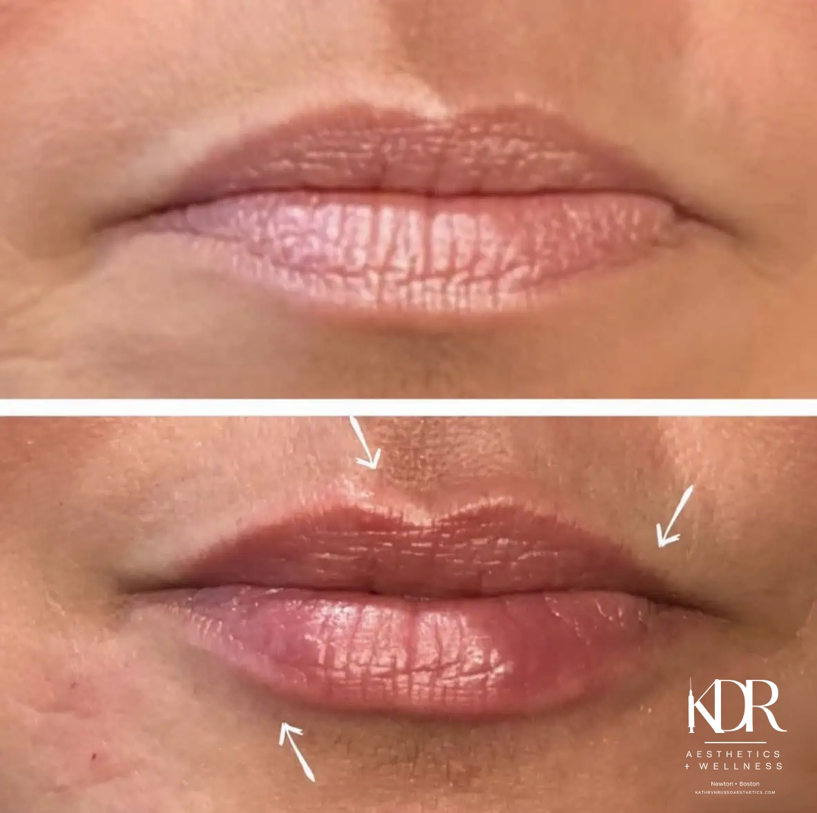 Facial Fillers before and after results