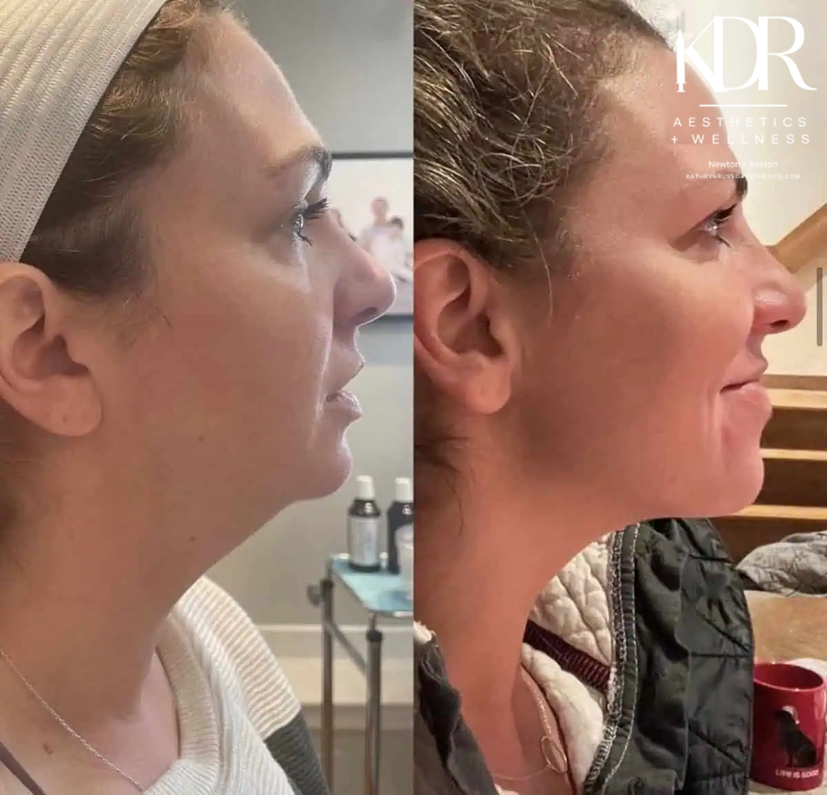 Before and after treatment results