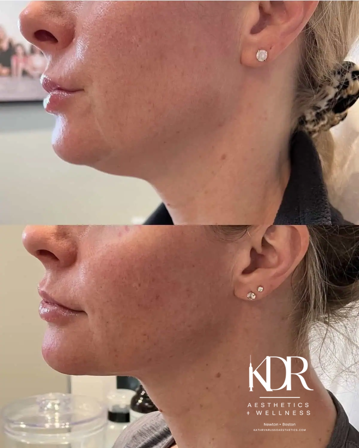 Before and after treatment results