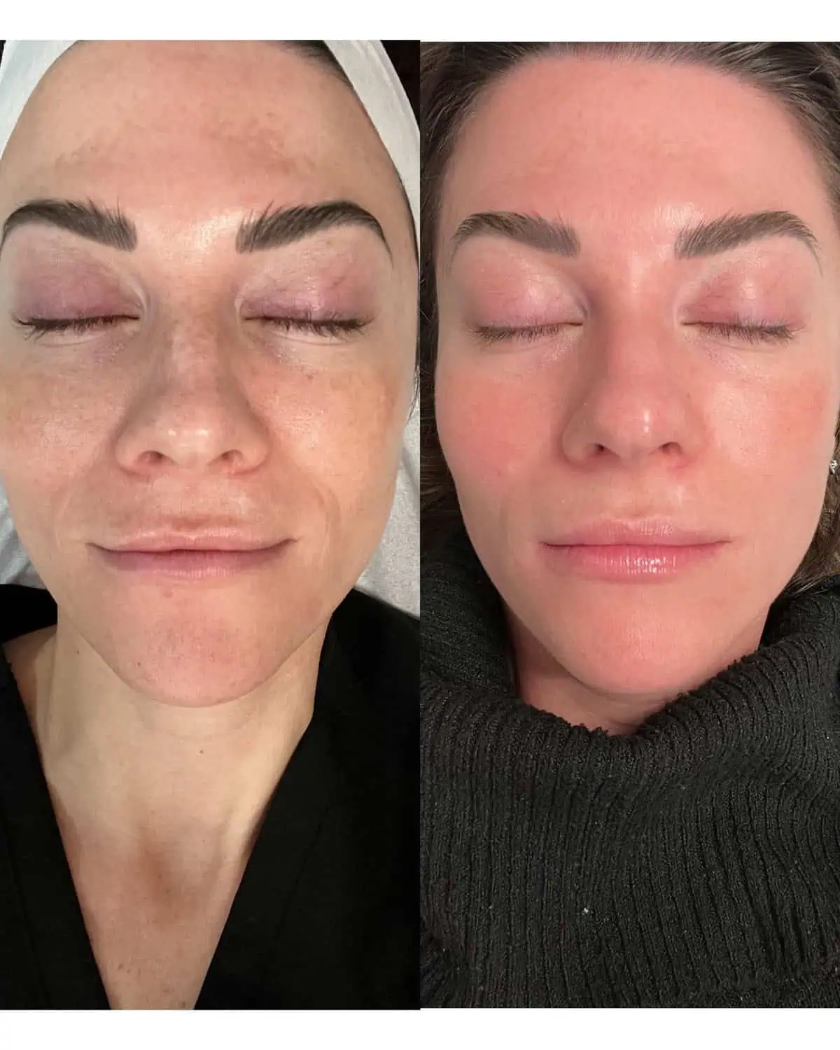 Facial Treatments before and after results