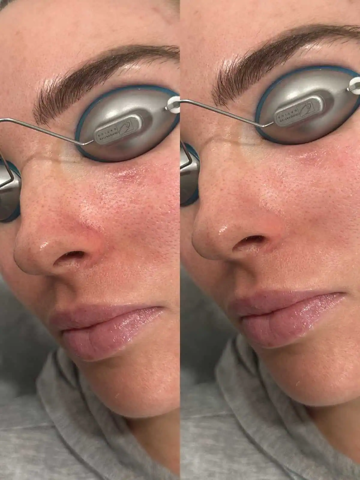 Facial Treatments before and after results