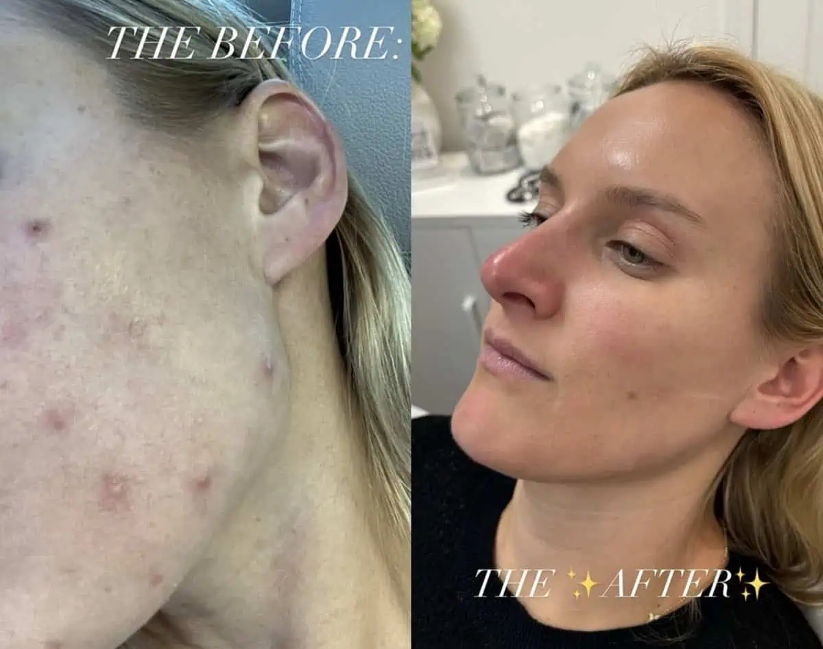 Facial Treatments before and after results