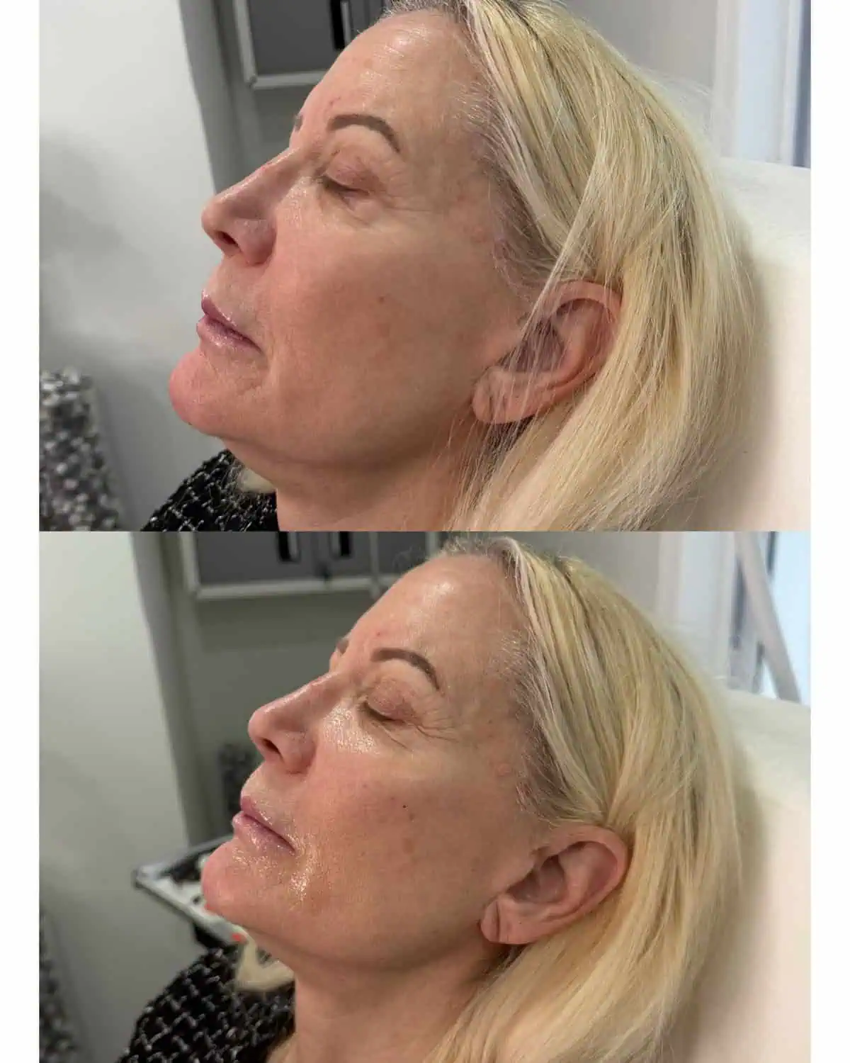 Facial Fillers before and after results