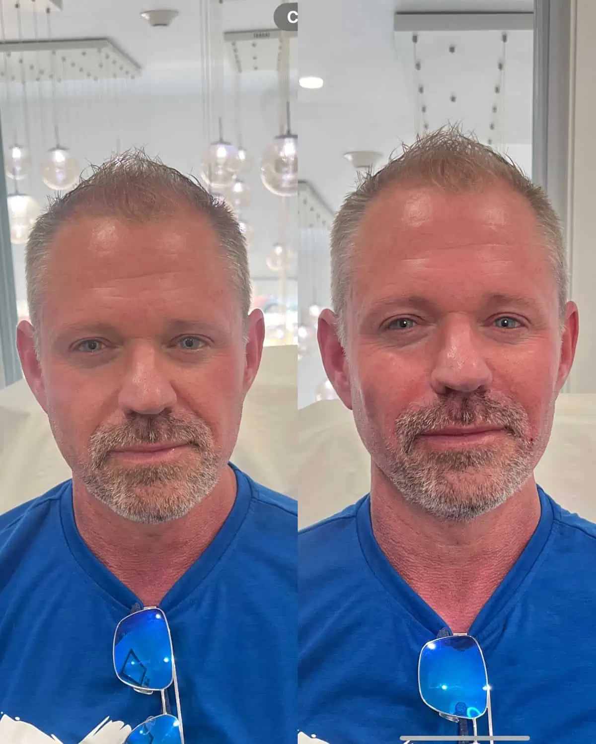 Facial Fillers before and after results