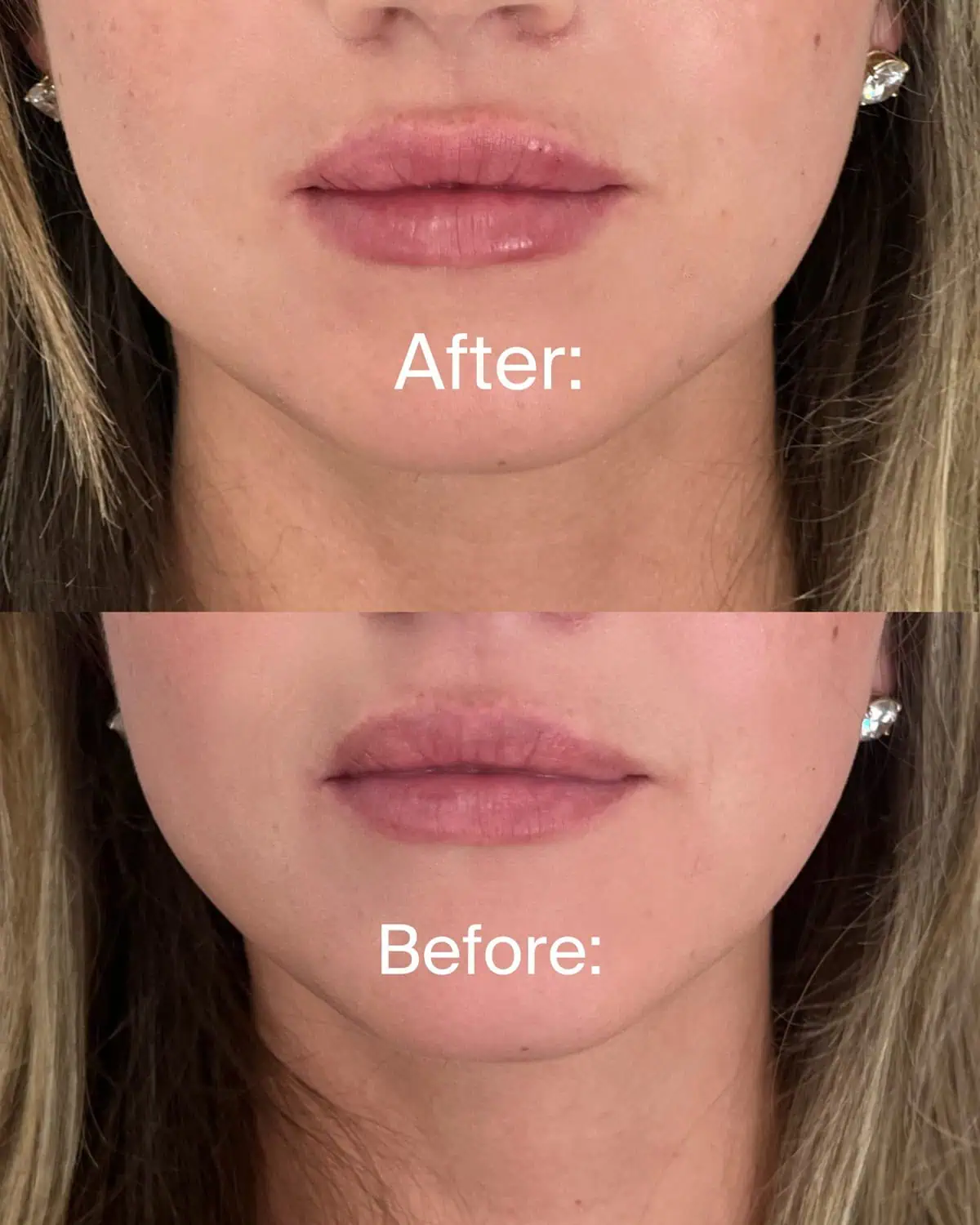 Facial Fillers before and after results