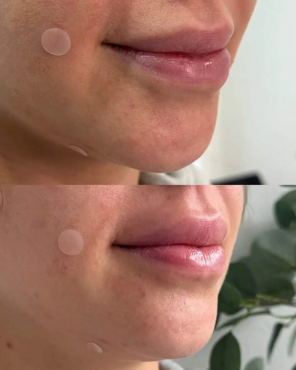 Facial Fillers before and after results