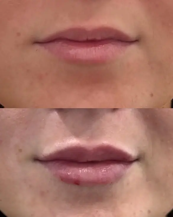 Facial Fillers before and after results