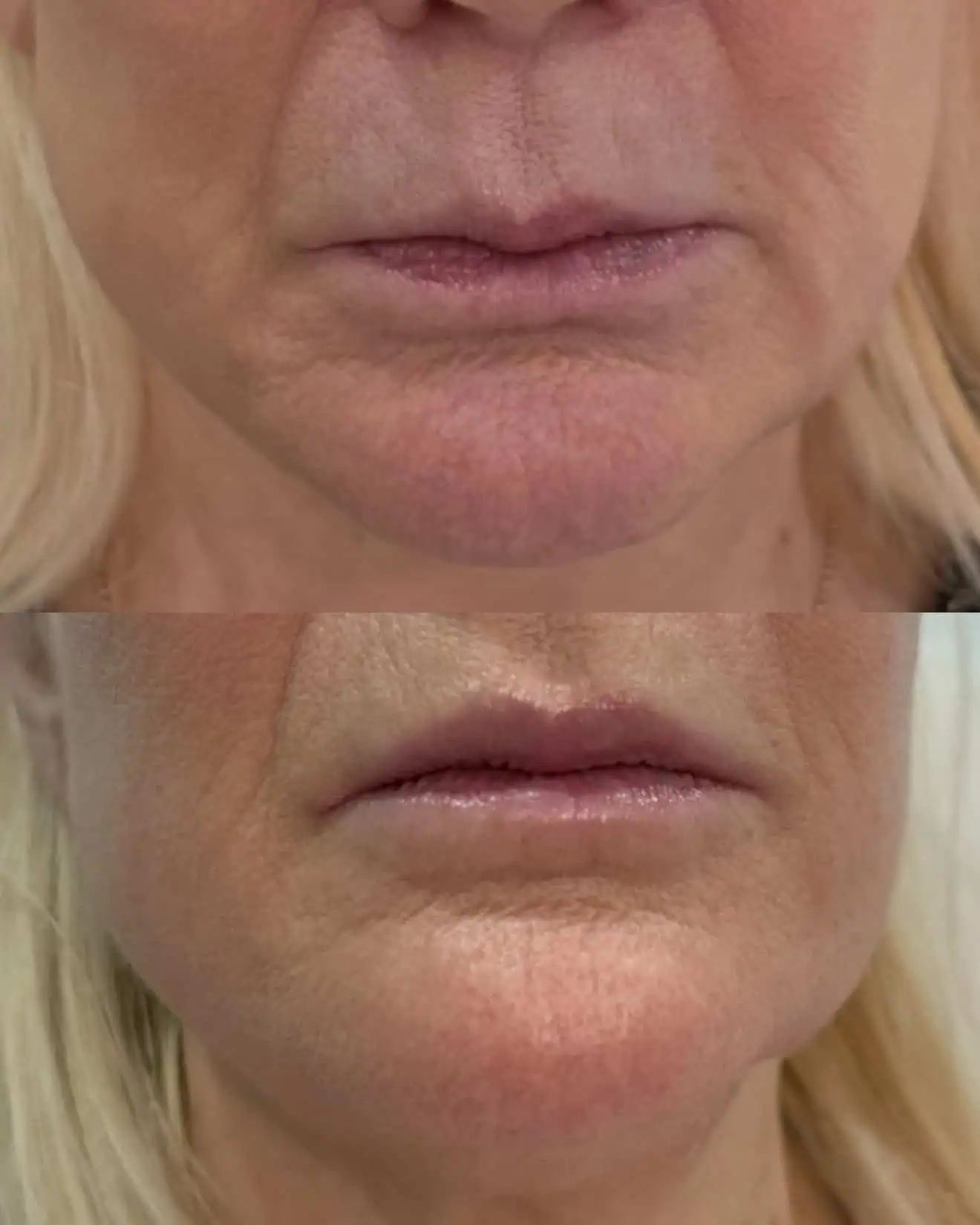 Facial Fillers before and after results
