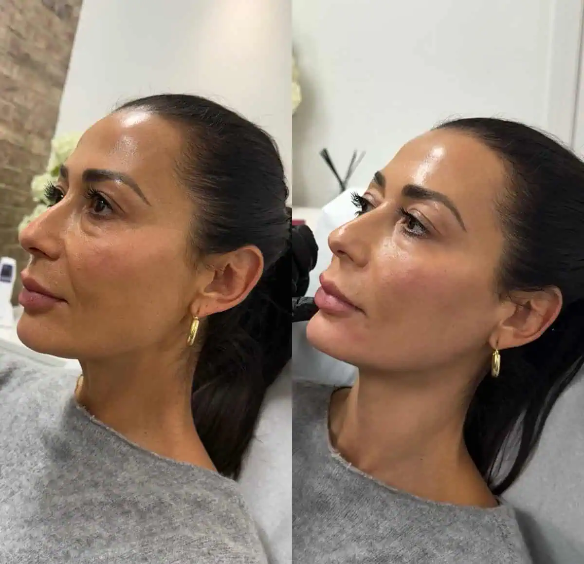 Facial Fillers before and after results