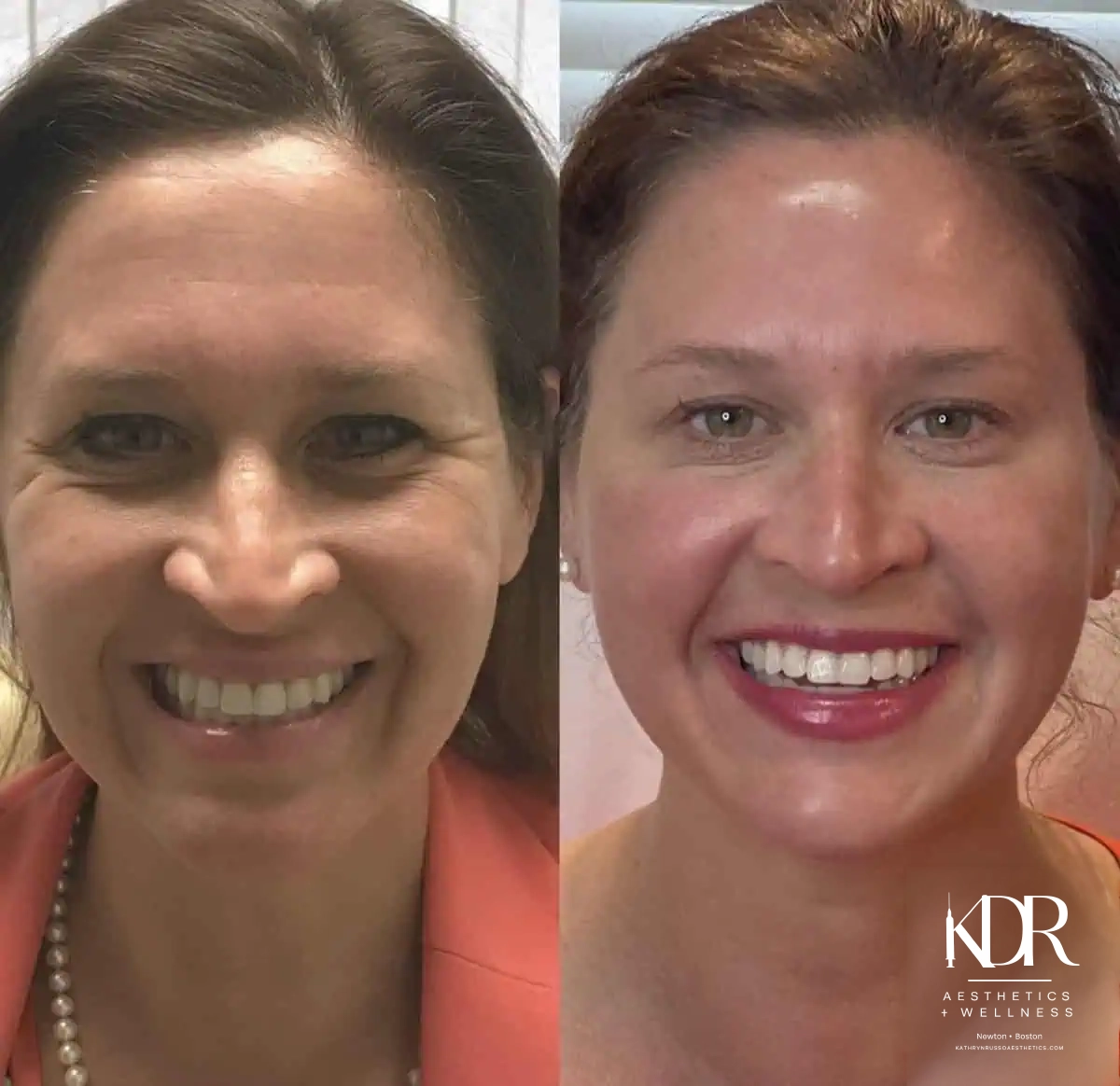 Facial Fillers before and after results