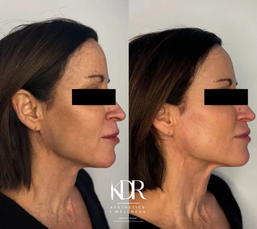 Facial Fillers before and after results