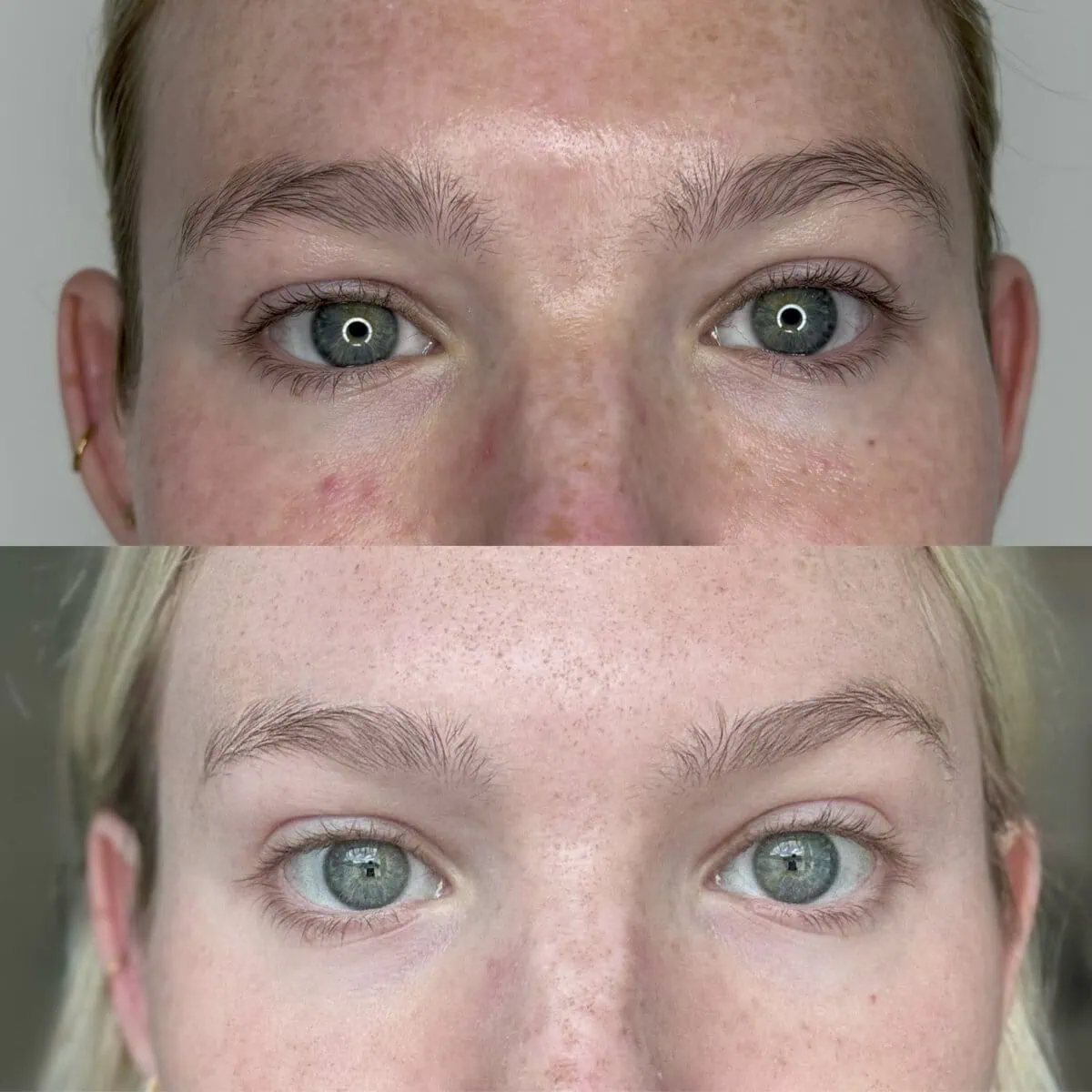 Botox before and after results