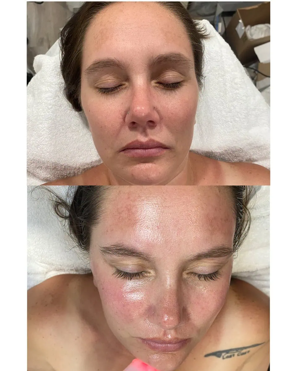 Facial Treatments before and after results