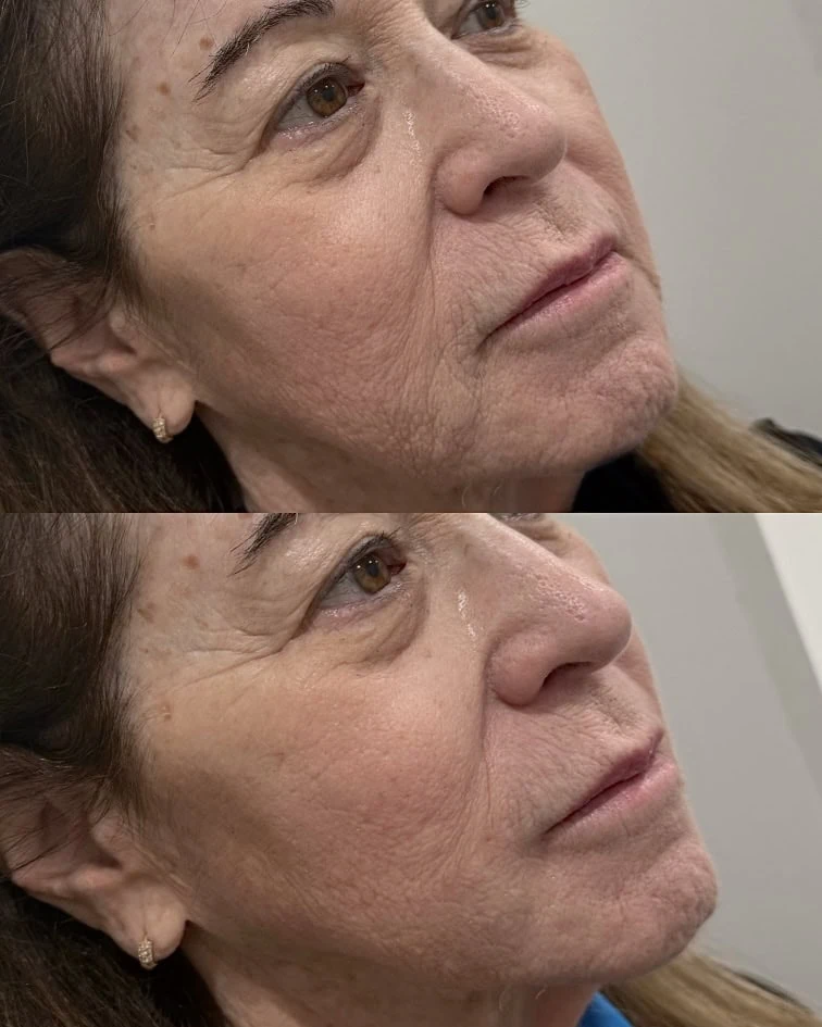 Facial Treatments before and after results