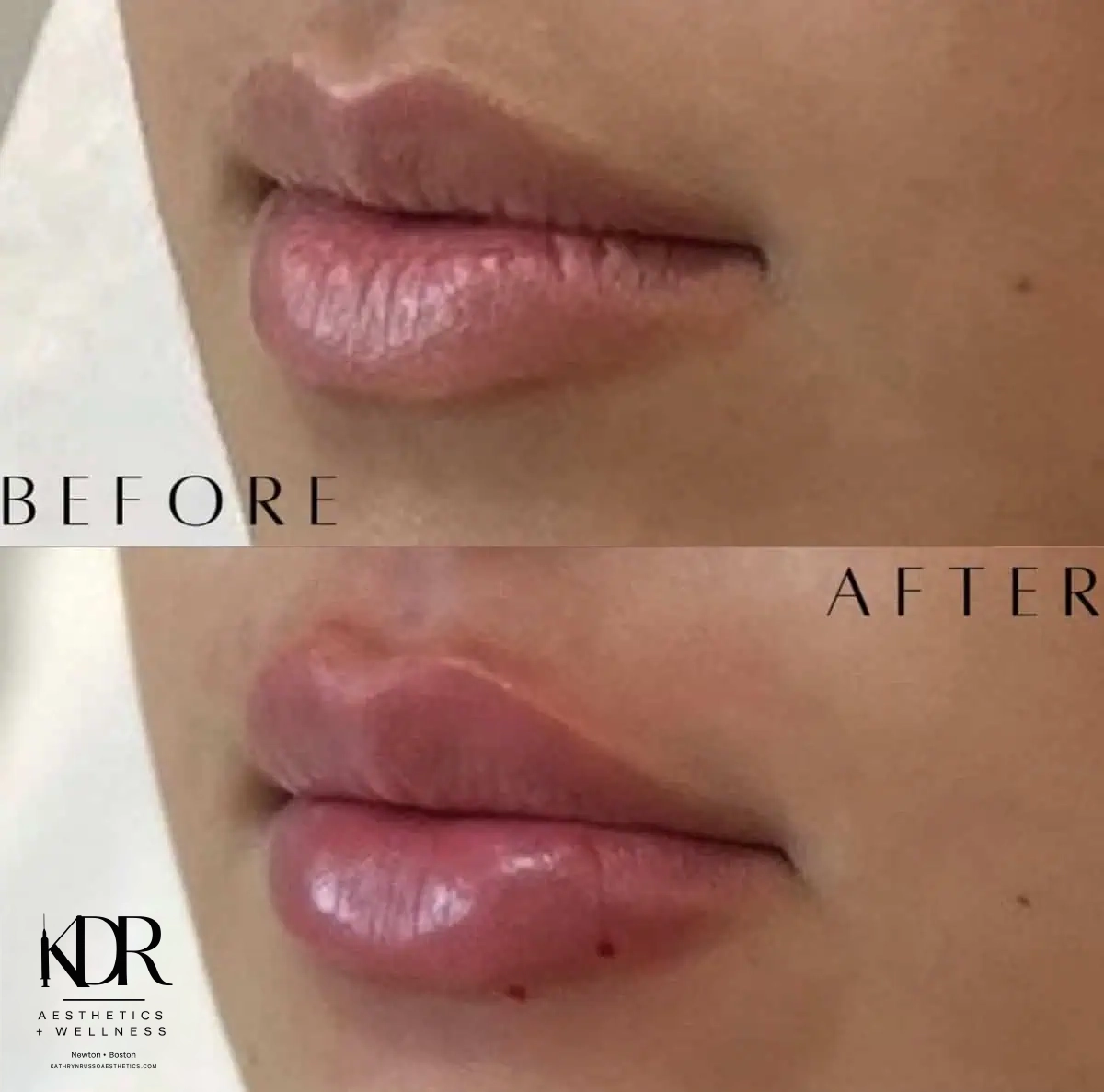 Facial Fillers before and after results